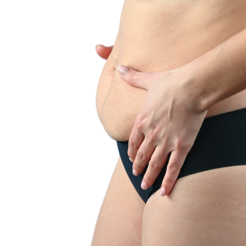 What is the difference between overweight belly, beerbelly, and the belly loosened after pregnancy (2)